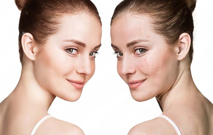 Mischhaut richtig pflegen – Naturkosmetik gegen Pickel und Unreinheiten in der T-Zone