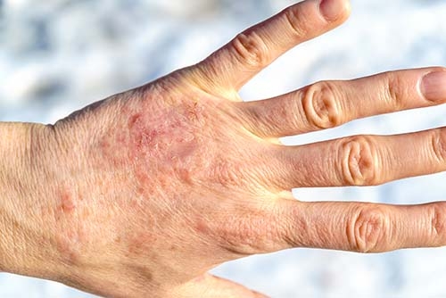 Ekzem auf Hand durch trockene Haut