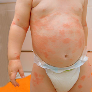 wie sieht neurodermitis aus - bilder neurodermitis schuppenflechte - bilder neurodermitis - wie sieht neurodermitis aus bilder - bilder neurodermitis im gesicht - bilder neurodermitis baby - bilder neurodermitis hände - bilder neurodermitis kinder - bilder neurodermitis rücken - wie sieht neurodermitis aus? - wie sieht neurodermitis aus bilder? - wie sieht neurodermitis aus auf der haut - bilder neurodermitis gesicht - atopisches ekzem bilder - atopisches ekzem kopfhaut - atopisches ekzem baby - atopisches ekzem behandlung - atopisches ekzem gesicht - atopisches ekzem genitalbereich - atopisches ekzem hand - atopisches endogenes ekzem - atopisches ekzem gesicht bilder - atopisches ekzem auge - atopisches ekzem neurodermitis gesicht - wie sieht ein atopisches ekzem aus? - atopisches ekzem fuß - atopisches ekzem hände - atopisches ekzem altmeyer - atopisches ekzem augenlid - atopisches ekzem scheide - atopisches ekzem homöopathie - atopisches ekzem mundwinkel - atopisches ekzem neurodermitis - atopisches ekzem finger - gesicht atopisches ekzem - atopisches ekzem lippe - atopisches ekzem fußsohle - atopisches ekzem ohne juckreiz - atopisches ekzem bei kindern - atopisches ekzem kleinkind - atopisches ekzem kind - atopisches ekzem bei kleinkindern tipps - atopisches ekzem bei kindern tipps - atopisches ekzem bei kleinkindern - kinder atopisches ekzem - atopisches ekzem kinder - kind atopisches ekzem - kleinkind atopisches ekzem -